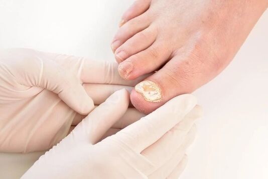 Doctors recommend Brand Fungent Bridge for the treatment of mycosis