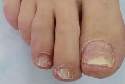 The nails were very affected by the mushroom
