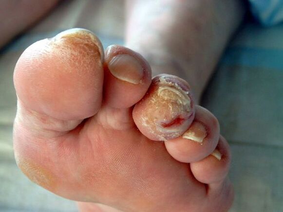 Diabetic and onychomicosis foot