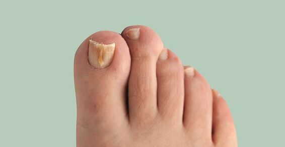 Nail fungus