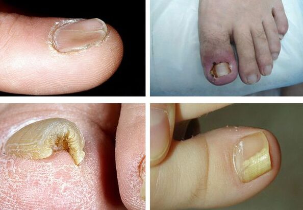 Symptoms of onychomycosis on the legs