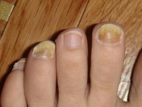 Fungus on the feet with damage to the nails